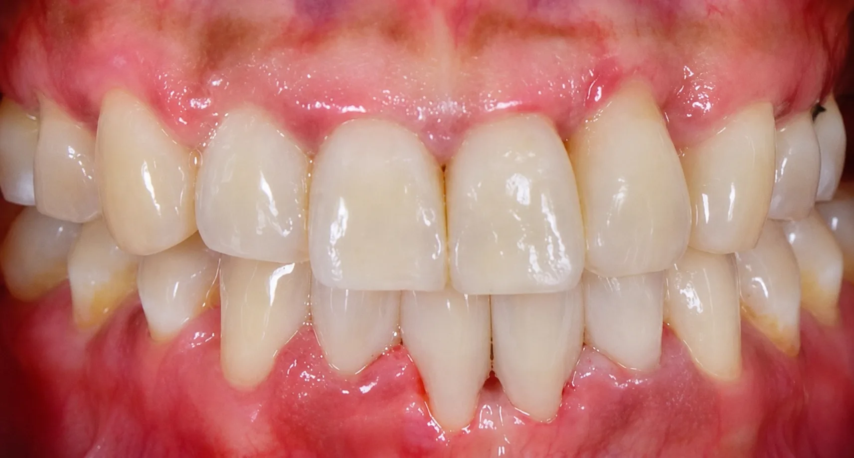 Upper front teeth after closing black triangles Johor
