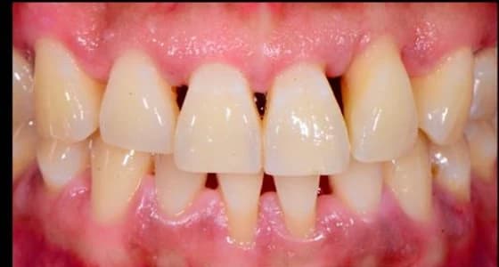 Black triangles between upper front teeth before treatment Johor