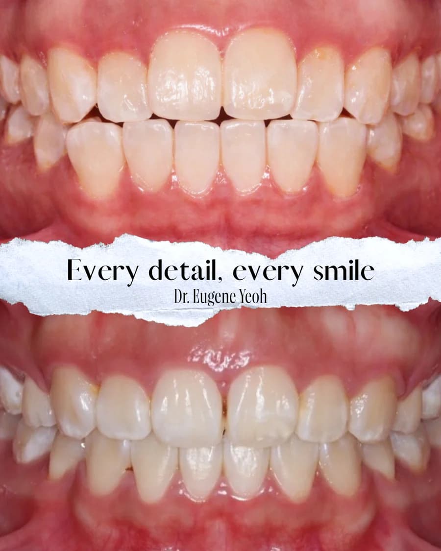 Before and after orthodontic treatment showing a refined, even bite Johor
