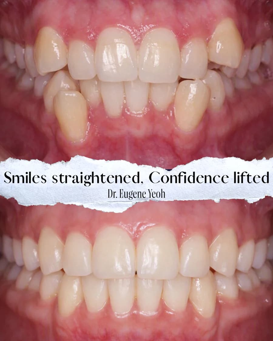 Before and after orthodontic treatment for crowded and protruding front teeth Johor