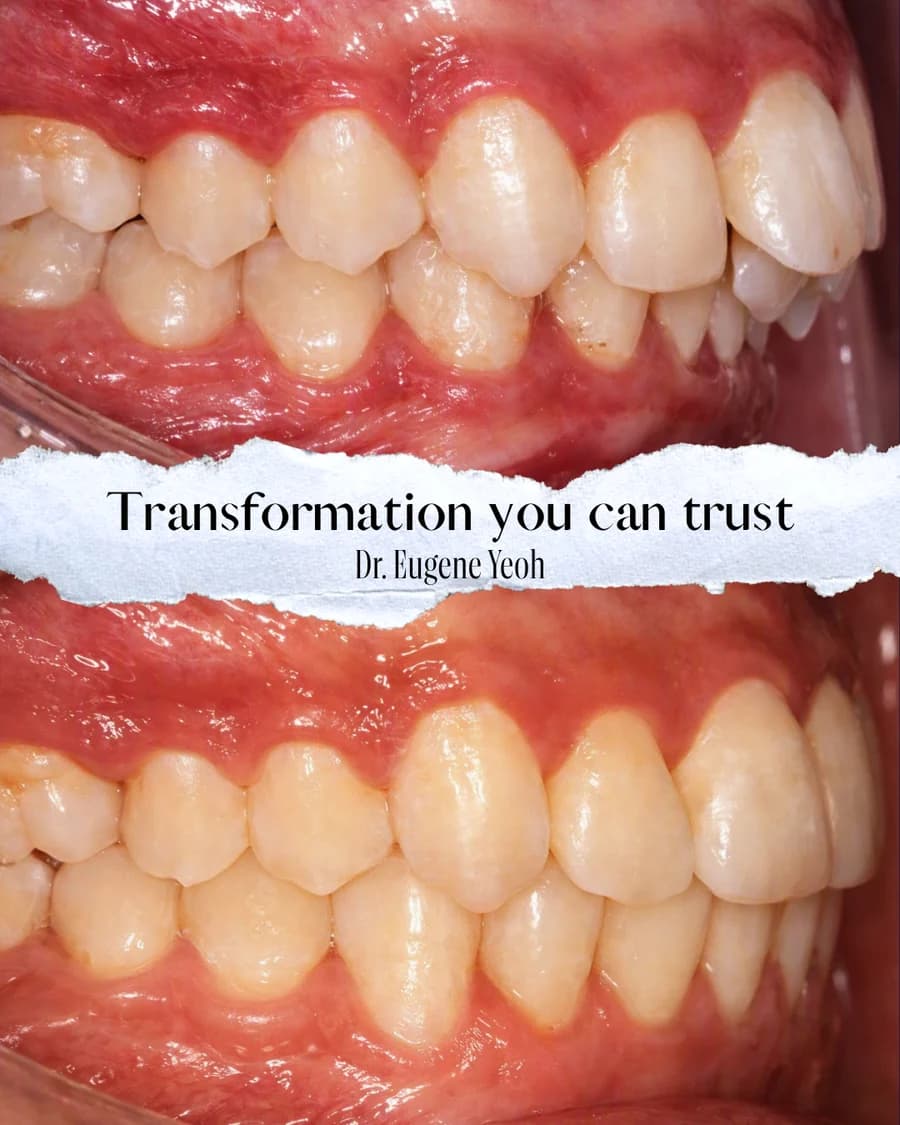 Before and after braces correcting a crossbite and irregular bite Johor