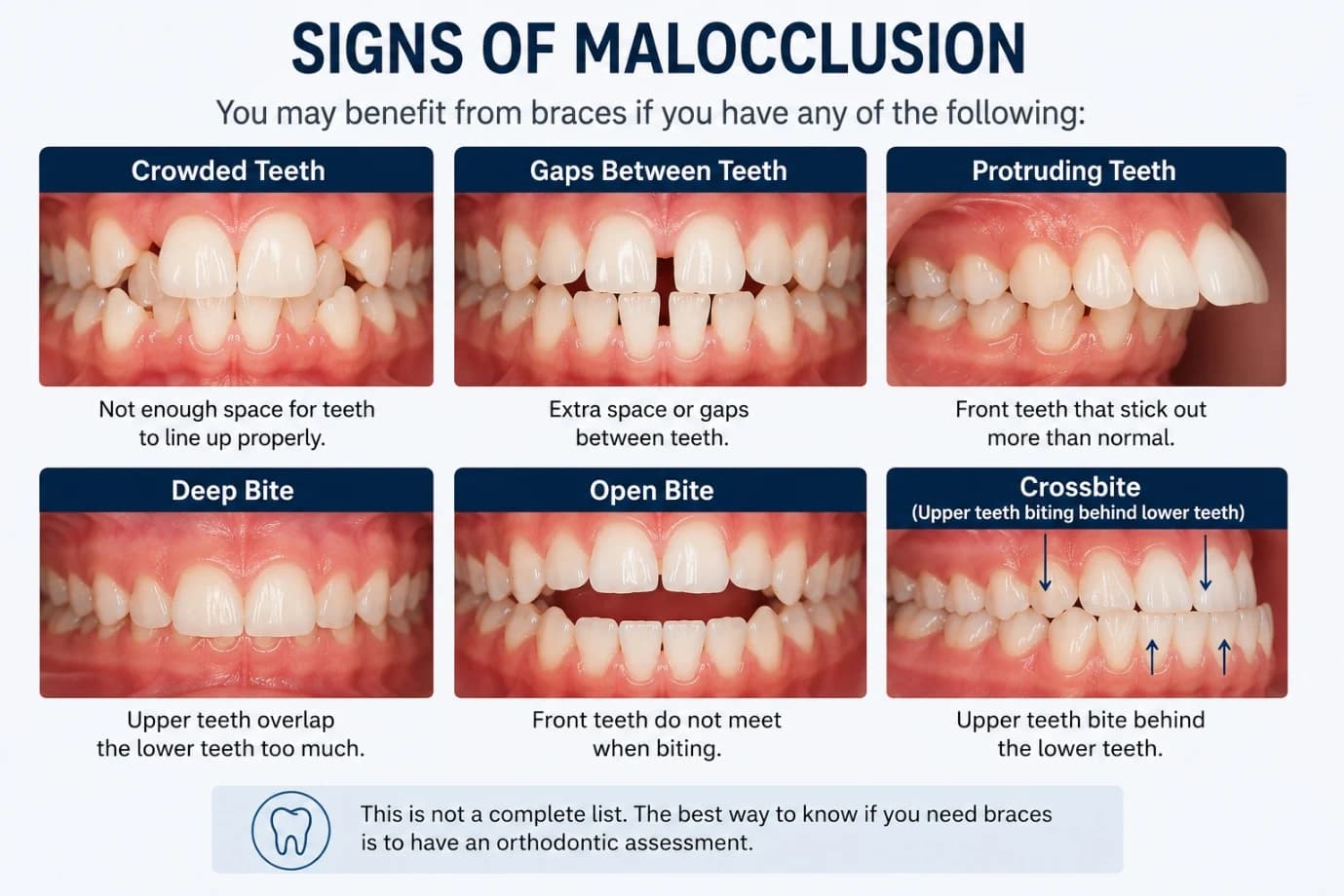 Signs of malocclusion: crowded teeth, gaps between teeth, protruding teeth, deep bite, open bite and crossbite