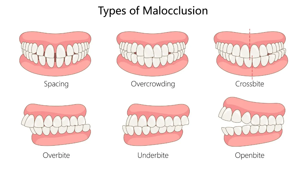 Types of malocclusion diagram: spacing, overcrowding, crossbite, overbite, underbite and openbite