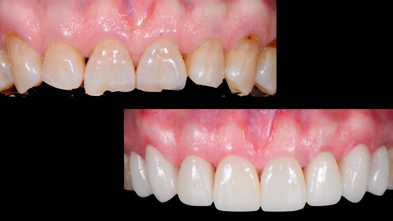Worn front teeth before and after composite veneers Johor
