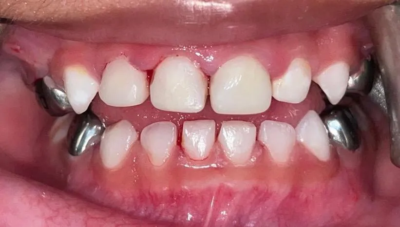 After: front teeth restored and back teeth crowned in a single visit under general anaesthesia
