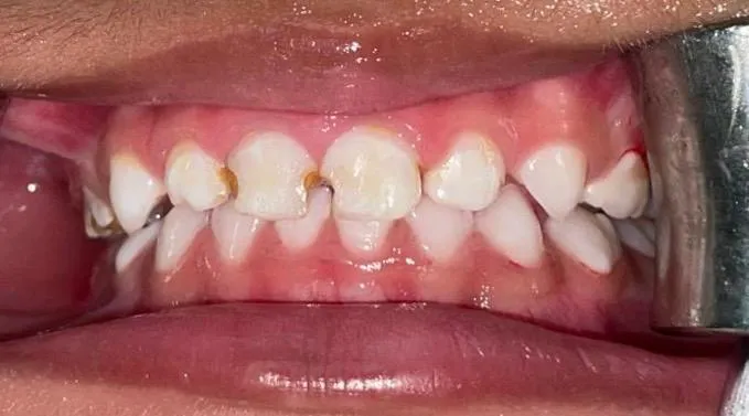 Before: multiple decayed primary front teeth in a 3.5-year-old child