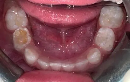 Before: lower arch showing decay of a primary molar