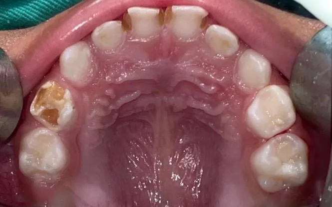 Before: upper arch showing extensive decay of the primary teeth