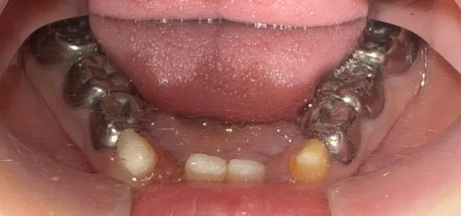 Lower arch after dental rehabilitation under general anaesthesia, with stainless steel crowns on the molars