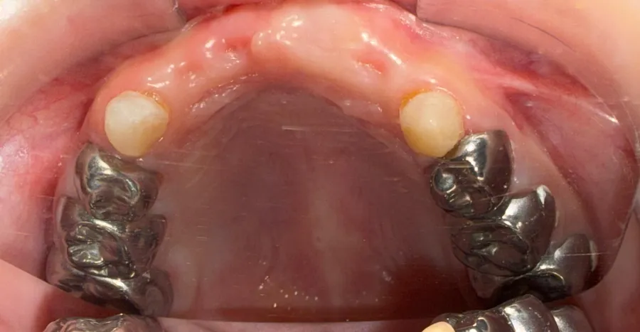 Upper arch after dental rehabilitation under general anaesthesia, with stainless steel crowns on the molars