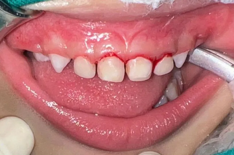 After treatment under general anaesthesia: the upper front teeth restored