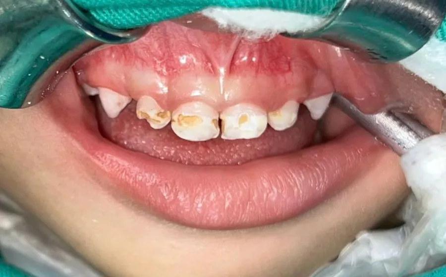 Before treatment: extensive decay affecting a child's upper front teeth