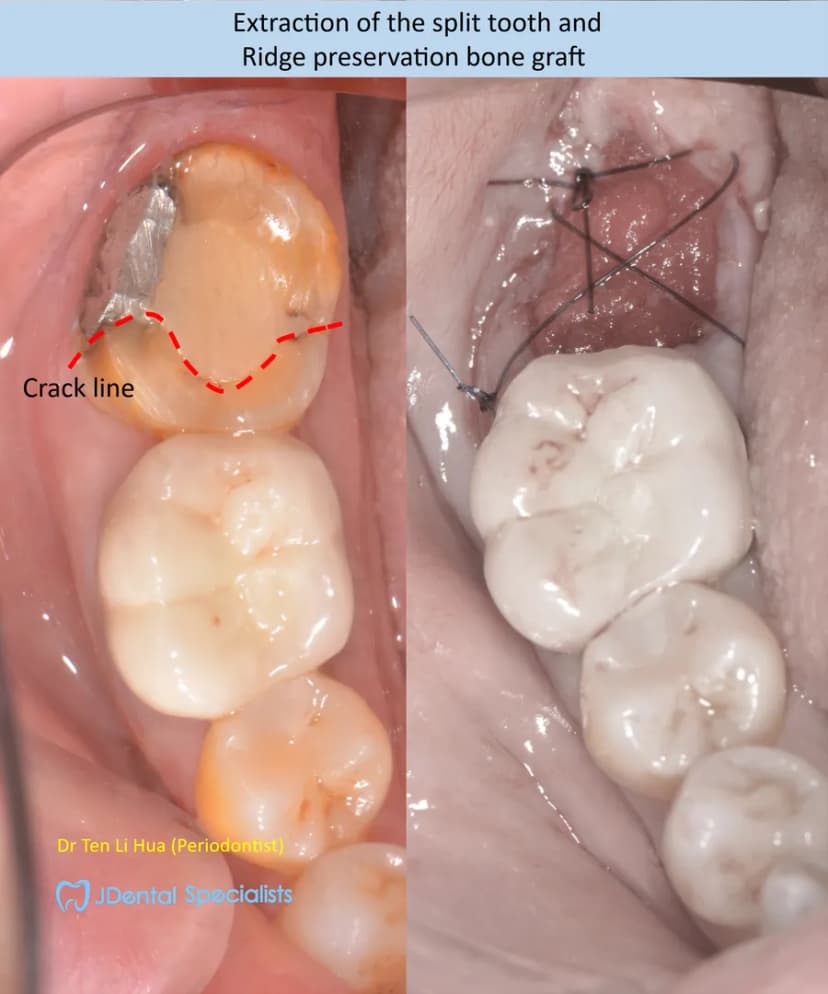 Extraction of the split tooth and ridge preservation bone graft — JDental Specialists Johor
