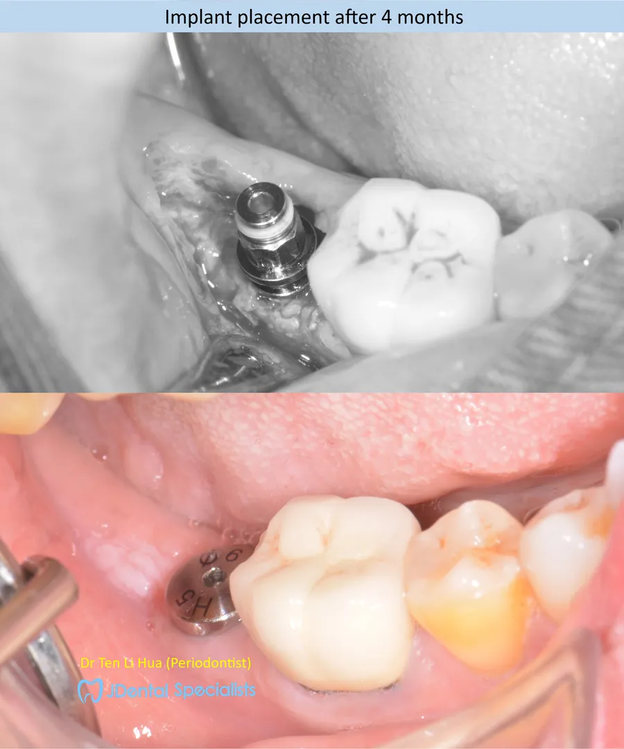 Implant placement after 4 months — JDental Specialists Johor
