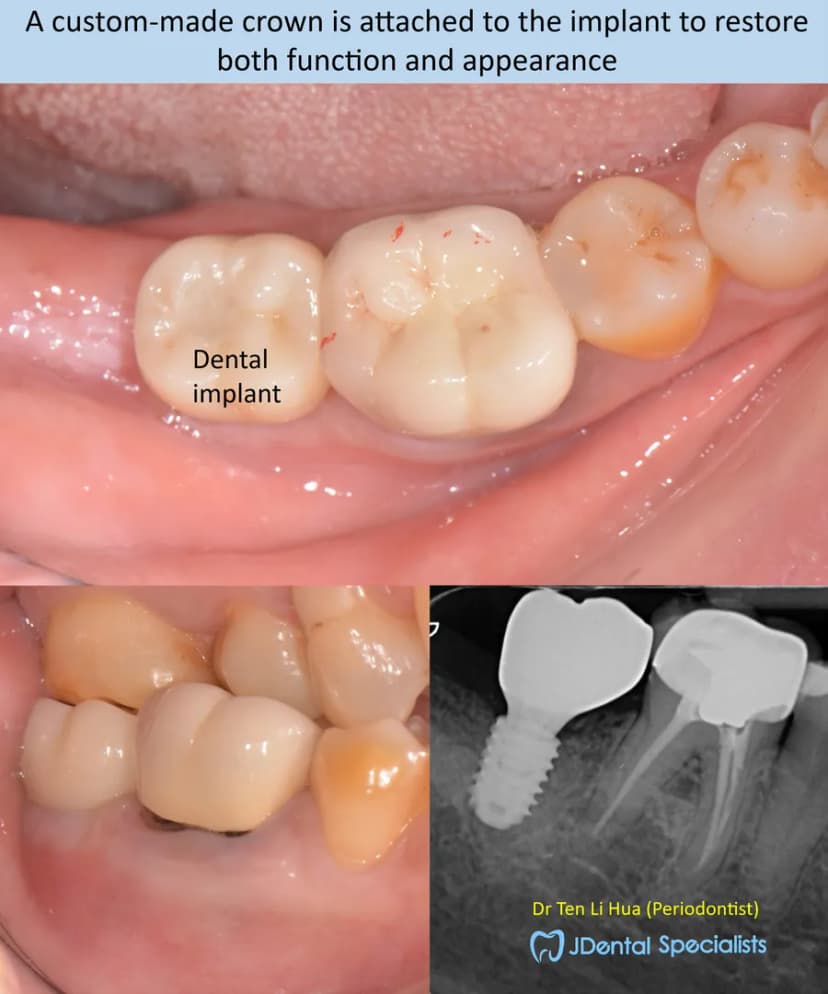 A custom-made crown attached to the implant to restore function and appearance — JDental Specialists Johor