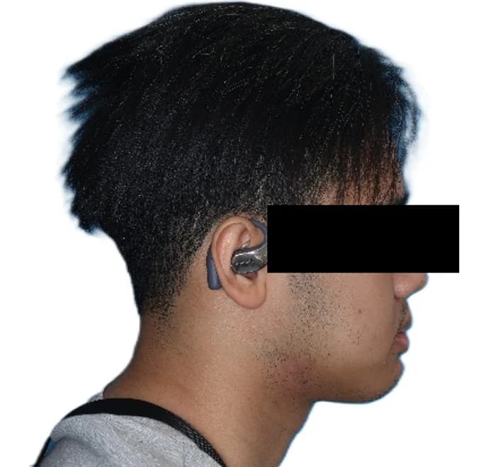 Patient profile after orthognathic corrective jaw surgery Johor