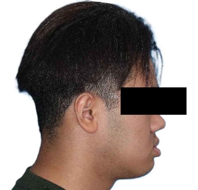 Patient profile before orthognathic corrective jaw surgery Johor