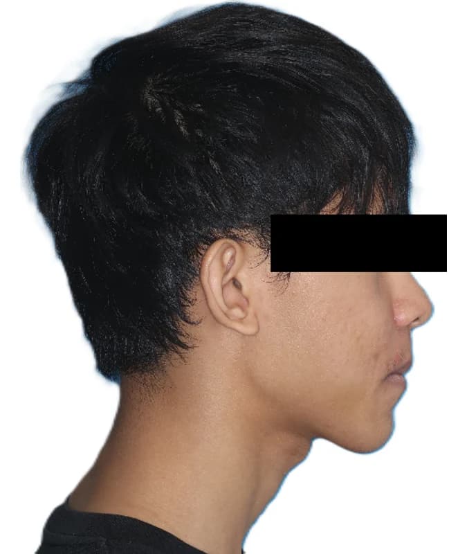 Balanced facial profile after orthodontic treatment and corrective jaw surgery Johor