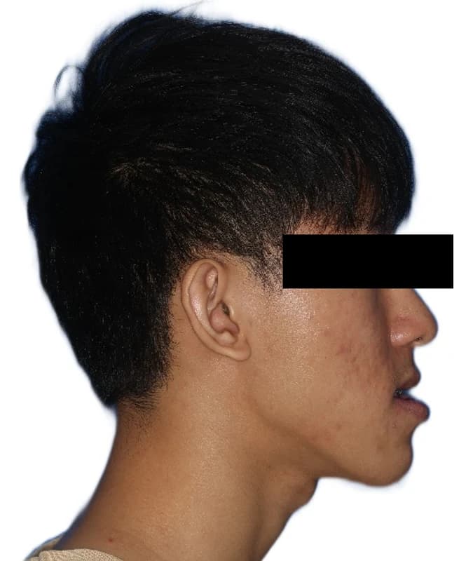 Facial profile before orthodontic treatment and corrective jaw surgery Johor