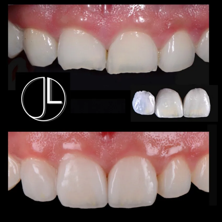 Front teeth before and after porcelain veneers, shown with the custom-made ceramic veneer shells