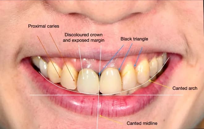 Smile analysis annotated with proximal caries, discoloured crown and exposed margin, black triangle, canted arch and canted midline