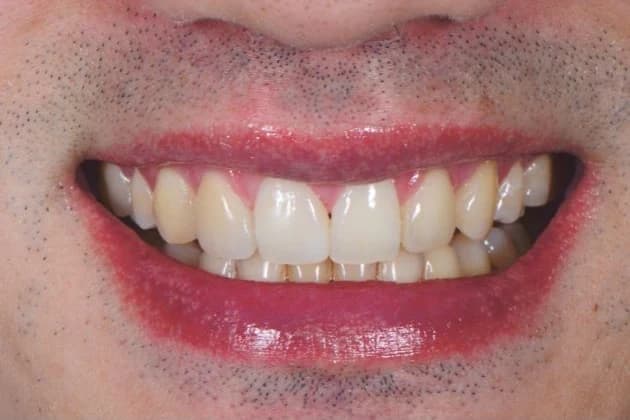 Balanced smile after improving tooth proportions Johor