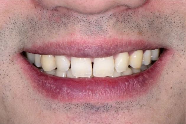 Smile before improving tooth proportions Johor