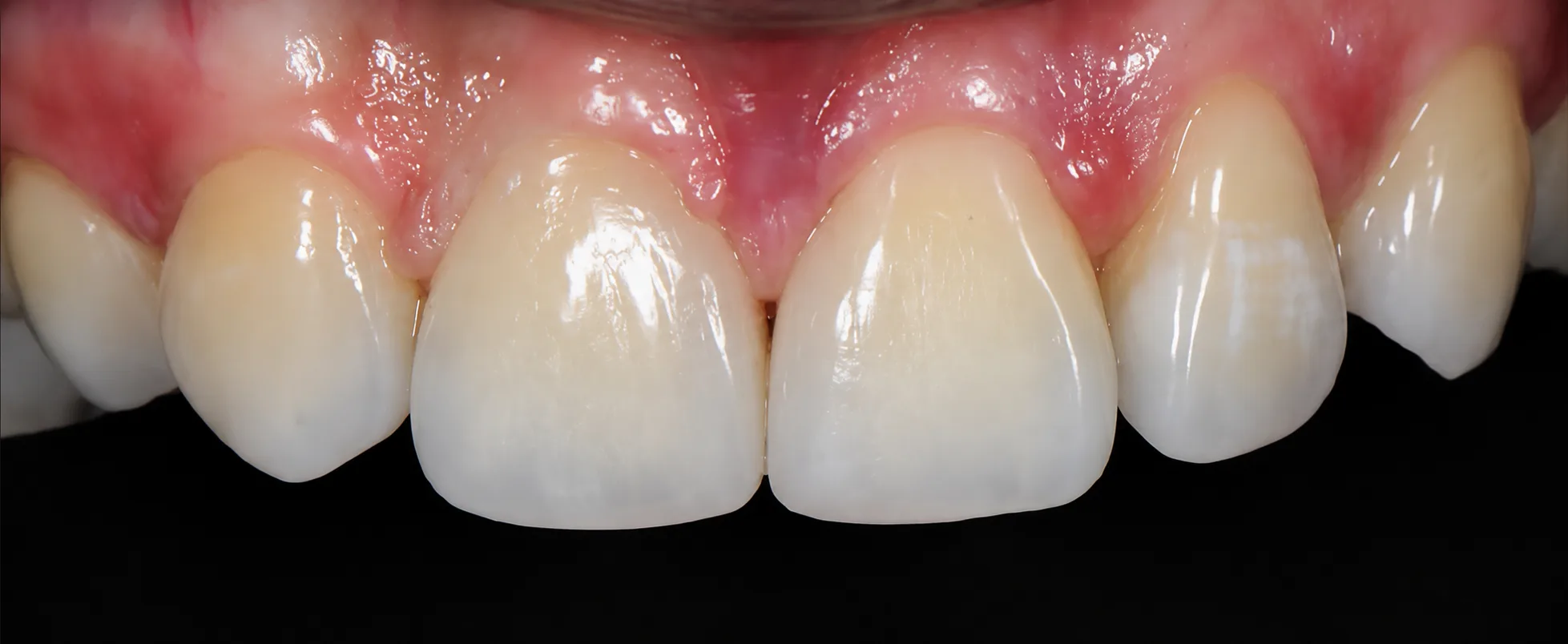 Front teeth after reshaping and contouring Johor