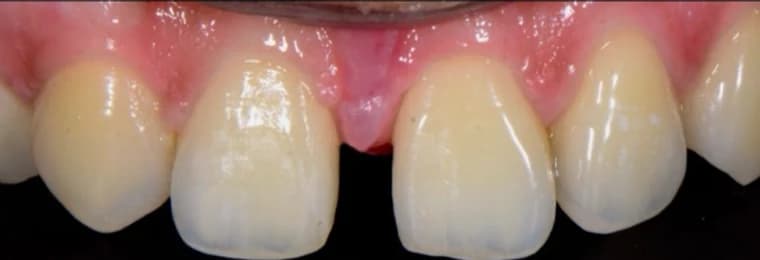 Front teeth before reshaping and contouring Johor