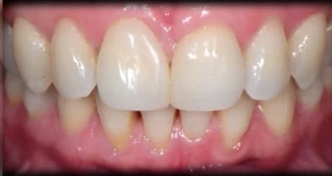 Closed gap after modifying tooth shape Johor