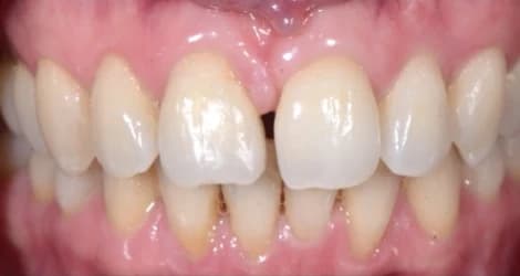 Gap between front teeth before treatment Johor