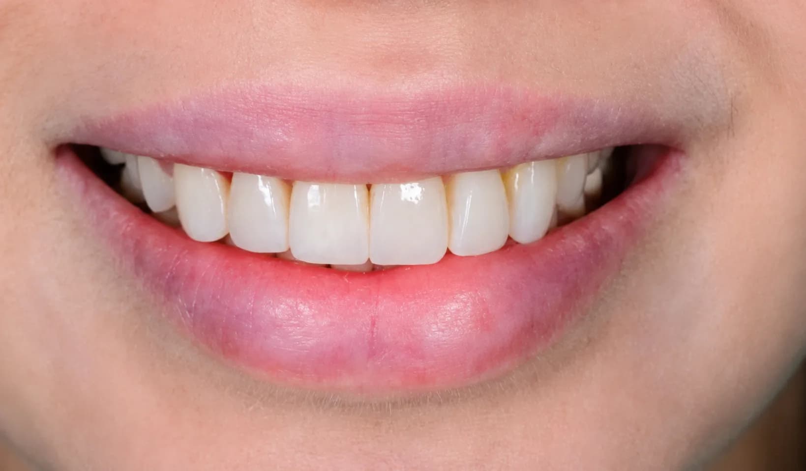 Natural-looking smile after porcelain veneers Johor
