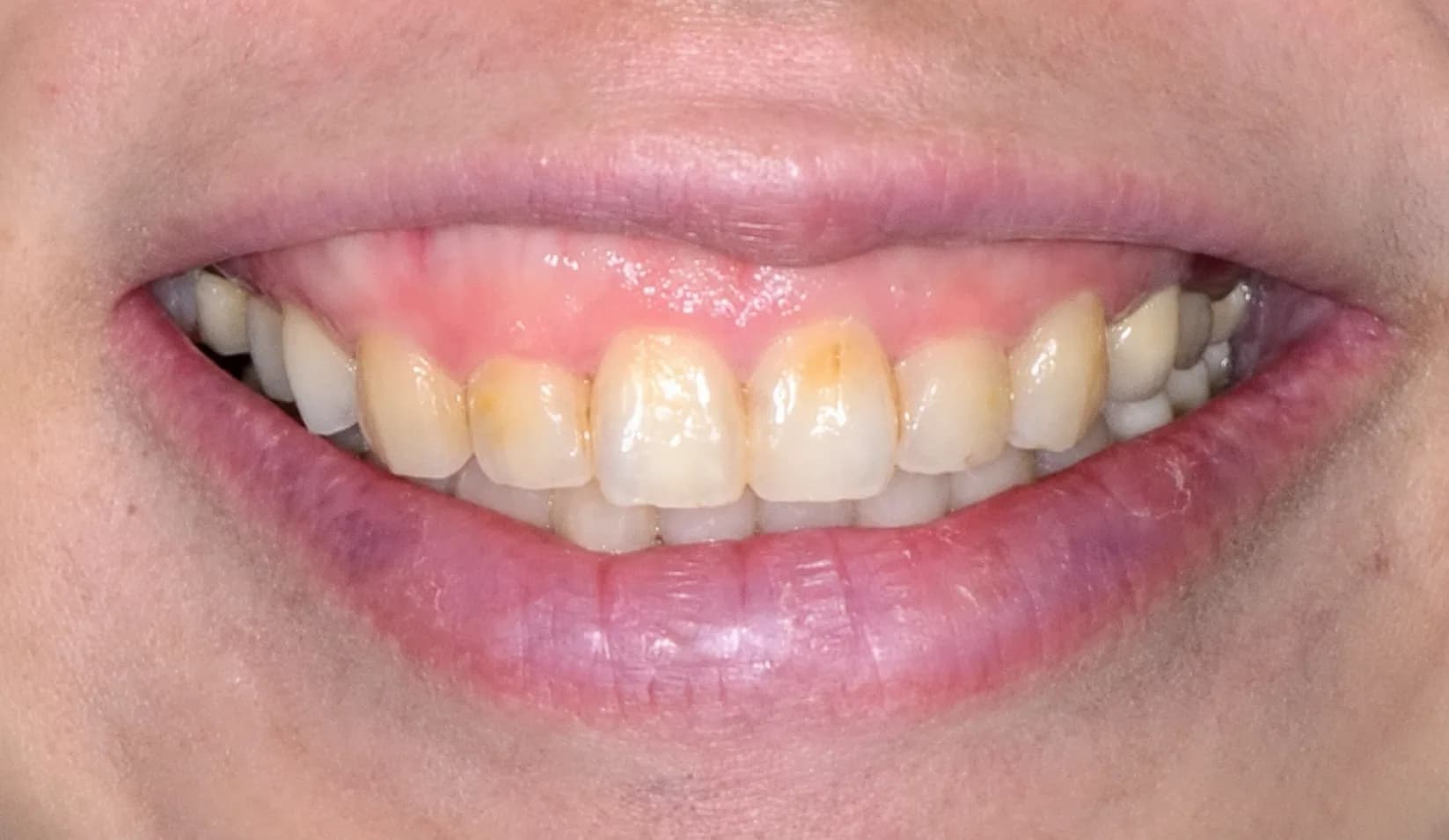 Discoloured teeth before porcelain veneers Johor