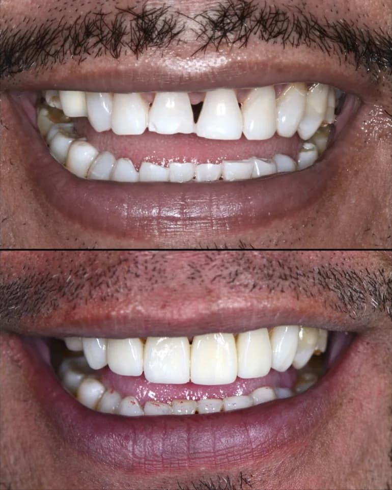 Gapped and chipped front teeth before and after veneers Johor