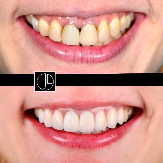 The same patient's smile before and after aesthetic treatment, with discoloration, black triangles and a canted midline corrected