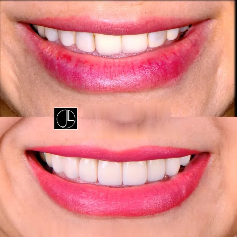 Smile before and after aesthetic dental treatment at JDental Specialists Johor
