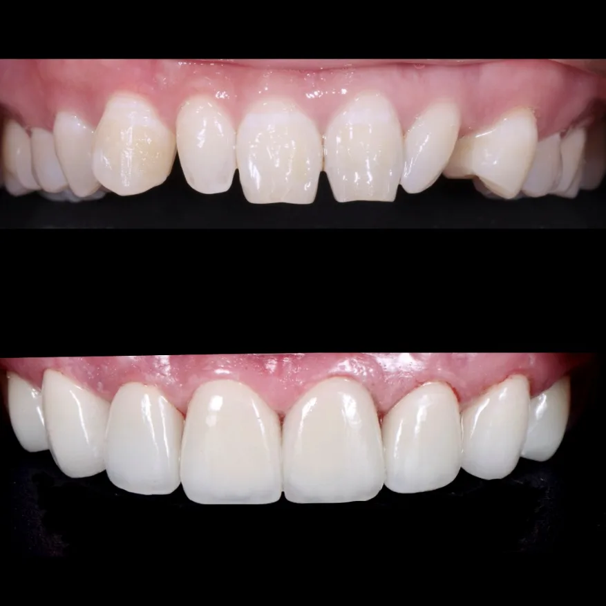 Uneven tooth edges and proportions before and after porcelain veneers Johor