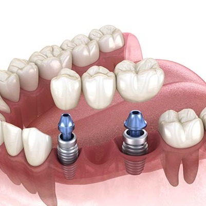 Prosthodontics